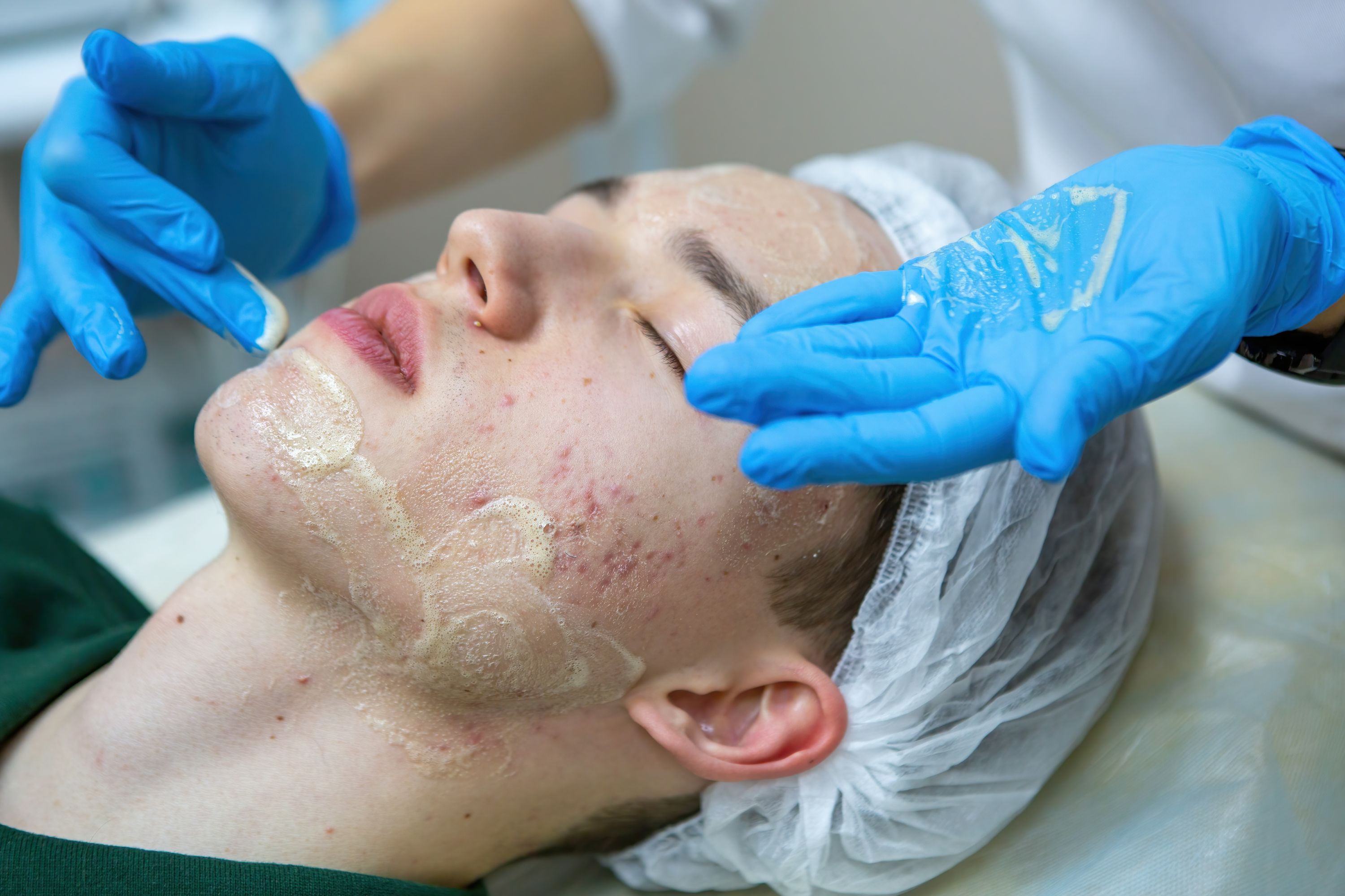 Acne behandeling gezicht huidverbetering Westland